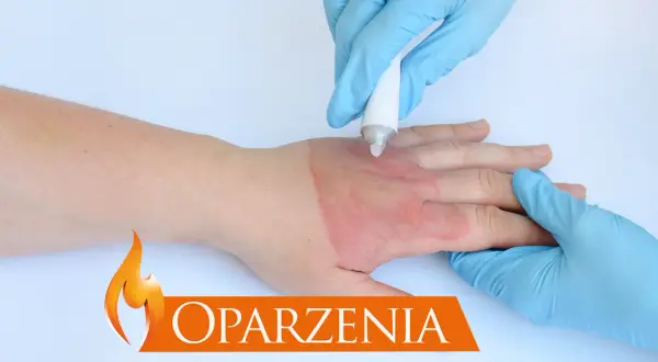 Ręka z oparzeniem, na którą nakładany jest preparat. Dowiedz się, jak zrobić opatrunek na oparzenia.