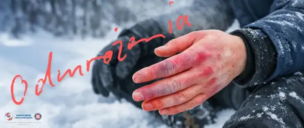 Dłoń z widocznymi zaczerwienieniami i sinymi palcami, sugerującymi odmrożenia. Czy odmrożenia znikają?