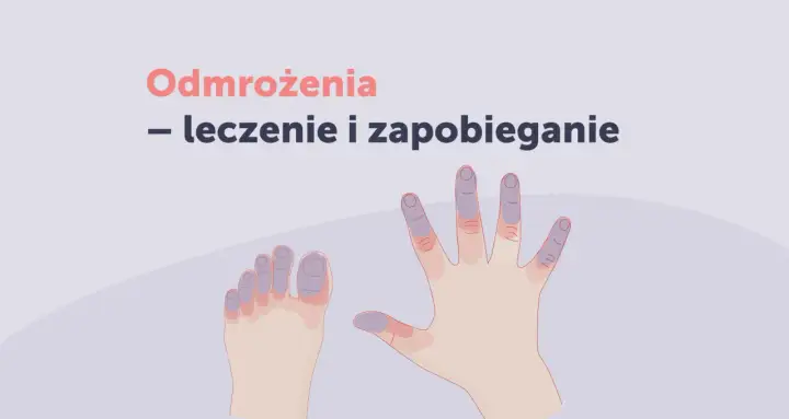 Dłonie i stopy z sinawo-fioletowymi palcami, ilustrujące różne rodzaje odmrożeń.